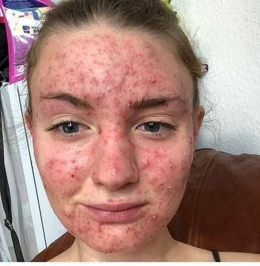 My Husbands Common Skin Rash Was Diagnosed as a Simple Food Allergy Until a Routine Blood Test Revealed a Severe and Life Threatening Form of Blood Cancer